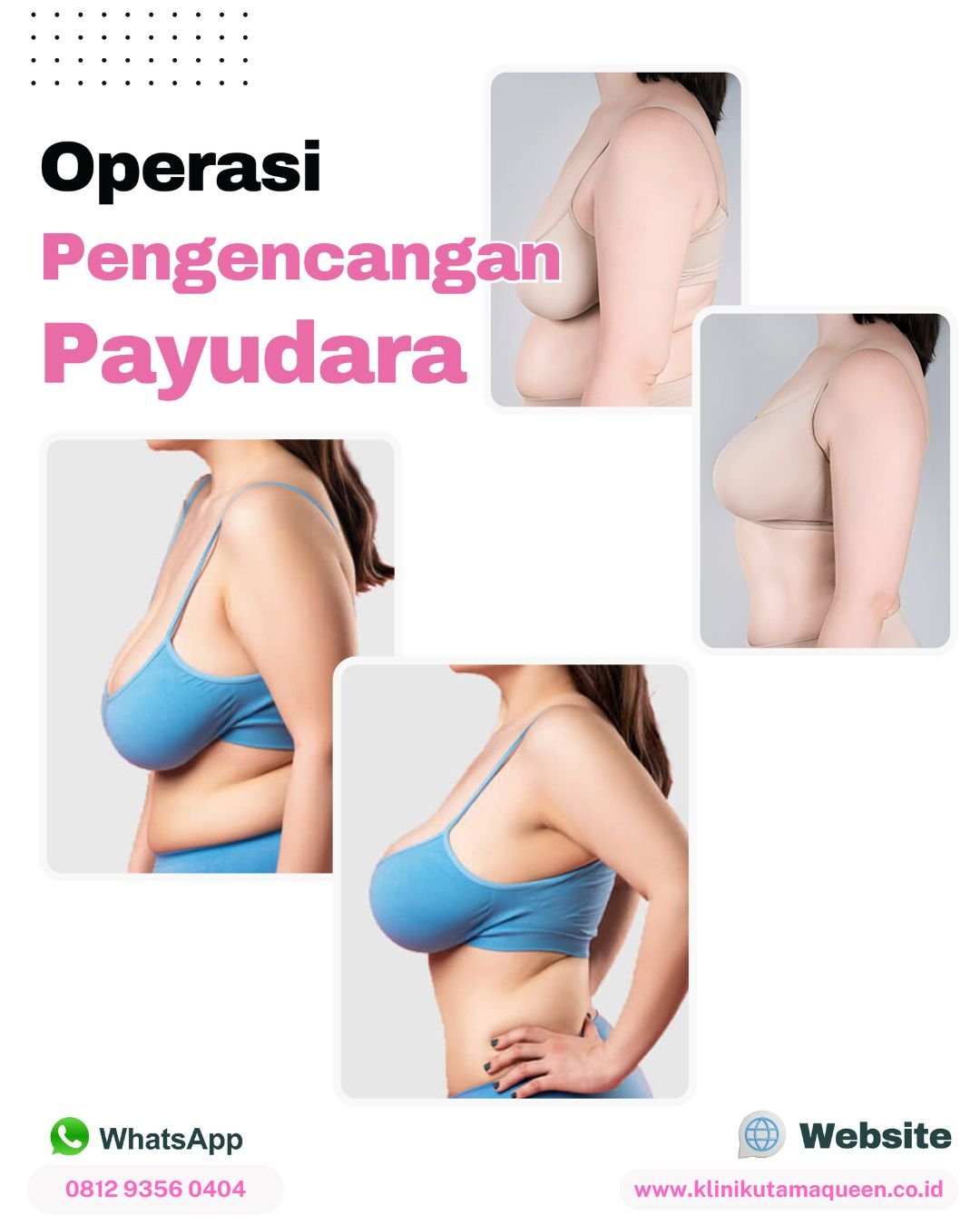 Operasi pengencangan payudara